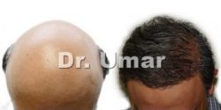  best hair fue restoration surgeon for reversing severe baldness by body hair transplant, Dr Umar and UGraft