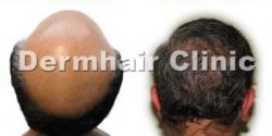  best hair fue restoration surgeon for reversing severe baldness by body hair transplant, Dr Umar and UGraft