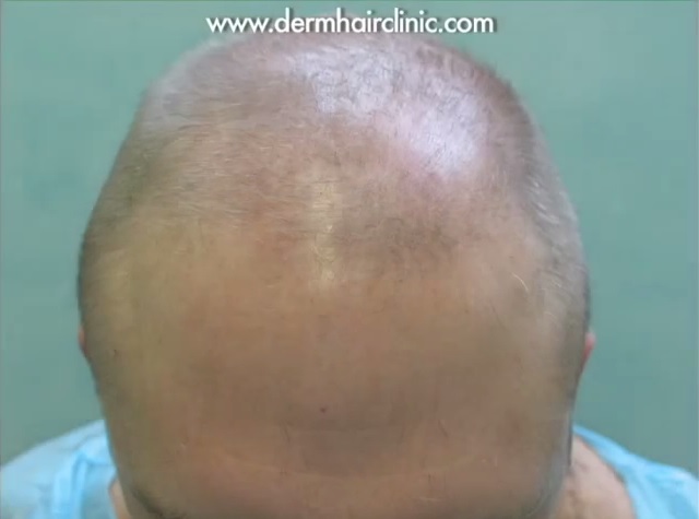 Severely Bald Norwood 6 Patient Before Body Hair Transplant