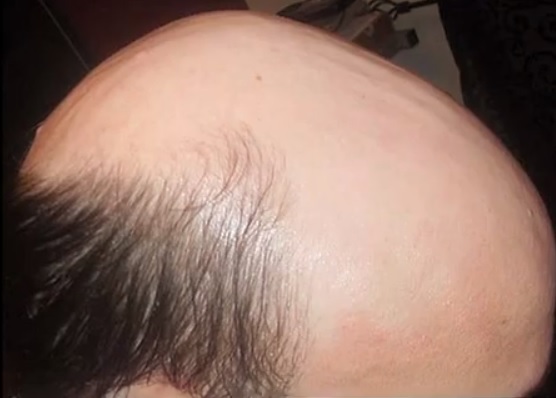 BMI and Causes For Severe Hair Loss in Men