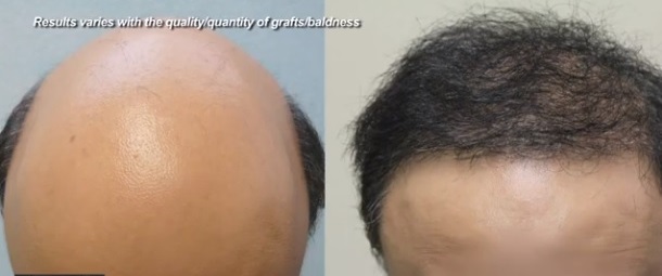 DermHair Clinic's Unique Hair Restoration Procedure The UGraft enables restoration of severe hair loss by Dr U