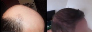 Genetic Pattern Baldness. Male Pattern Baldness | Factors