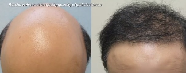 Hair Transplant Procedures| New Possibilities