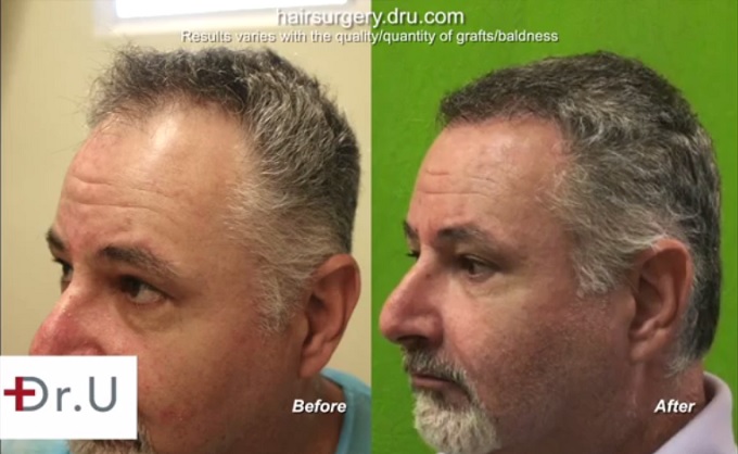 New FUE Mature Hairline & Temples| Profile View New FUE Mature Hairline & Temples| Profile View