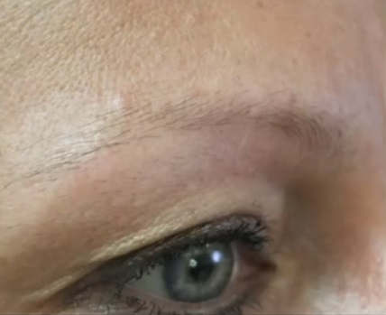 Patient's Sparse Eyebrows Before FUE Surgery