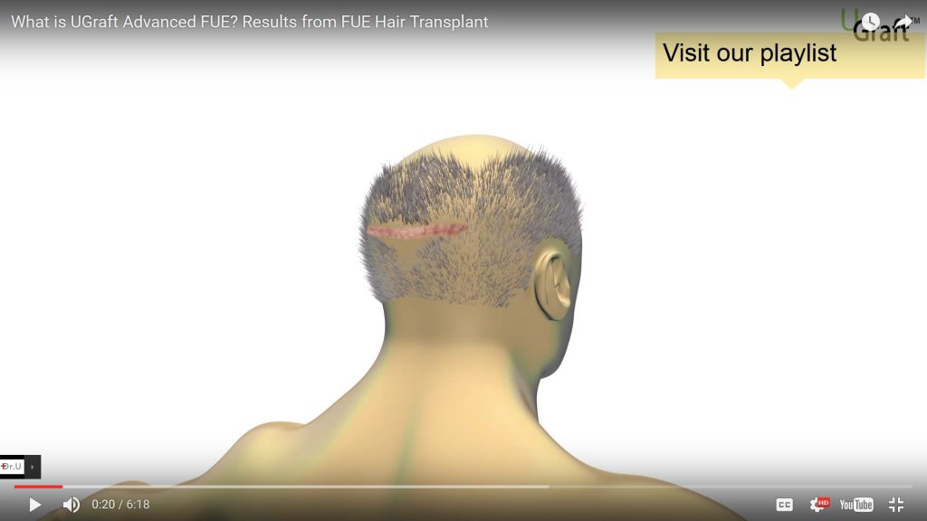 Strip scar is an inevitable result of strip hair surgery hair restoration method called FUSS