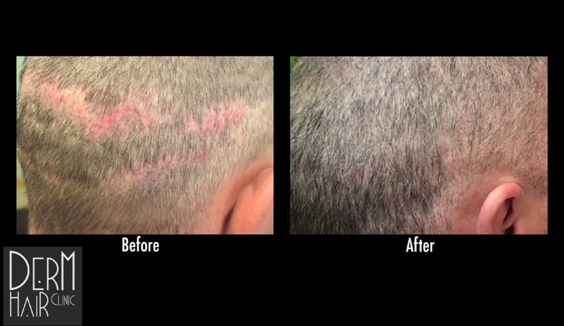 Advanced FUE Repairs Botched Strip Surgery Results