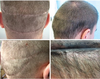 Strip Scarring - Repair Through FUE Surgery