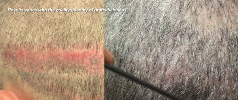 Strip Scar Repair Using FUE and Body Hair Transplantation