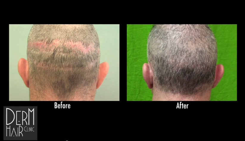 Before and after hair transplant Step-by-Step Situation - Desmoderm