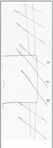 Hair Transplant Strip Surgery Scar Repair by UGraft - Pearls Hair Transplant Strip Surgery Scar Repair by UGraft - Pearls