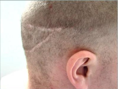 Strip Scar| Patient Photo| Articles By Dr. Umar Strip Scar| Patient Photo| Articles By Dr. Umar