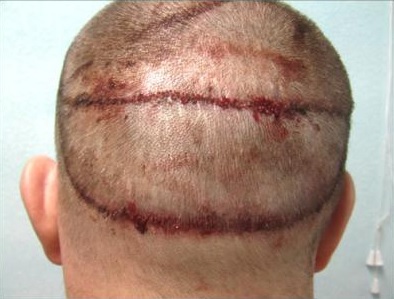 Strip Scar Repair| Post-Op Strip Scar Repair| Post-Op