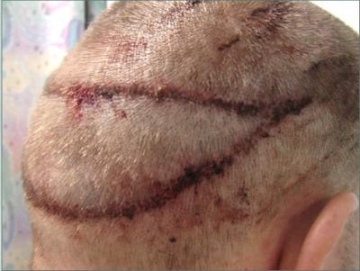 Strip Scars|Post-Op|Right Side View Strip Scars|Post-Op|Right Side View