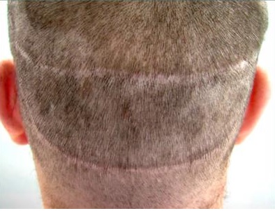 Two Strip Scars| Hair Transplant Repair|BHT Surgery|Patient Photo Before Procedure