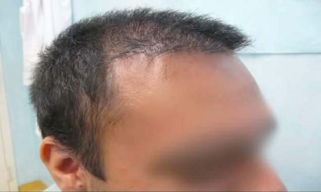 Patient Before Strip Surgery Hairline Revision with FUE