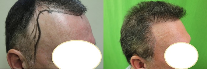 Hair Transplant Cost| Medical Tourism