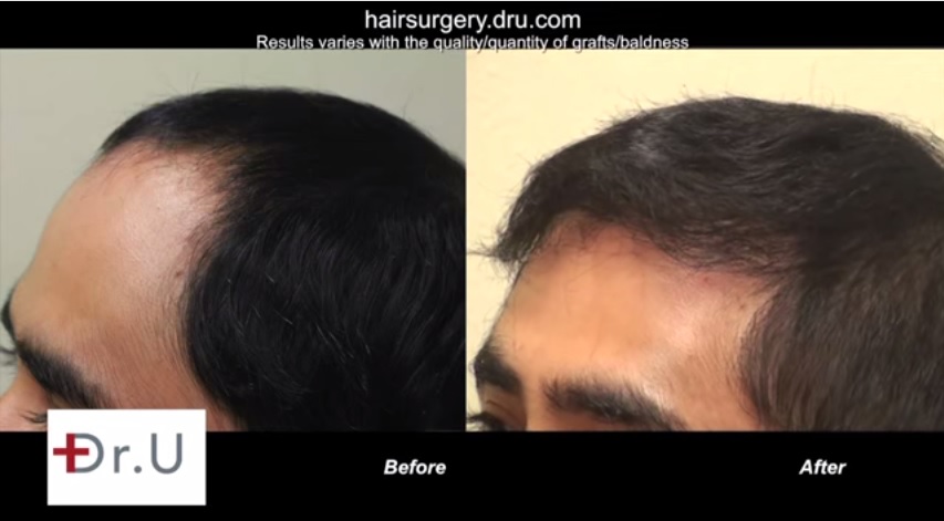 Temple Hair Restoration| FUE| Patient Results