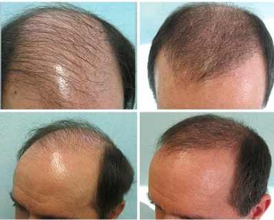 FUE For Treating BaldnessFUE For Treating Baldness