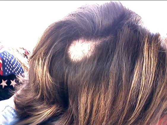 Dealing with the hair disease trichotillomania