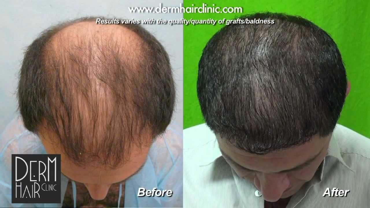 hair transplant grafts head fue dr umar restoration crown baldness