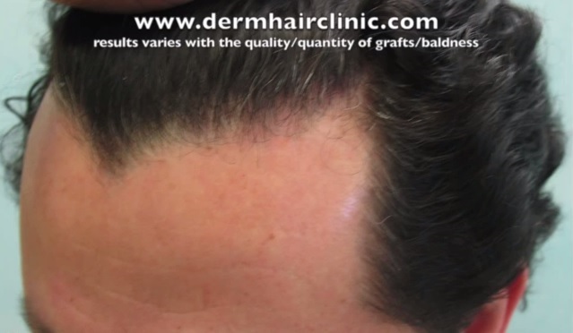 Patient With Sharp Widow's Peak Hairline - Before FUE Surgery