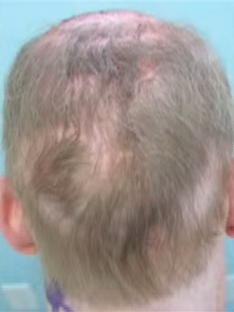 Impossible Hair Repair Case| New Hope With Body Hair Transplantation