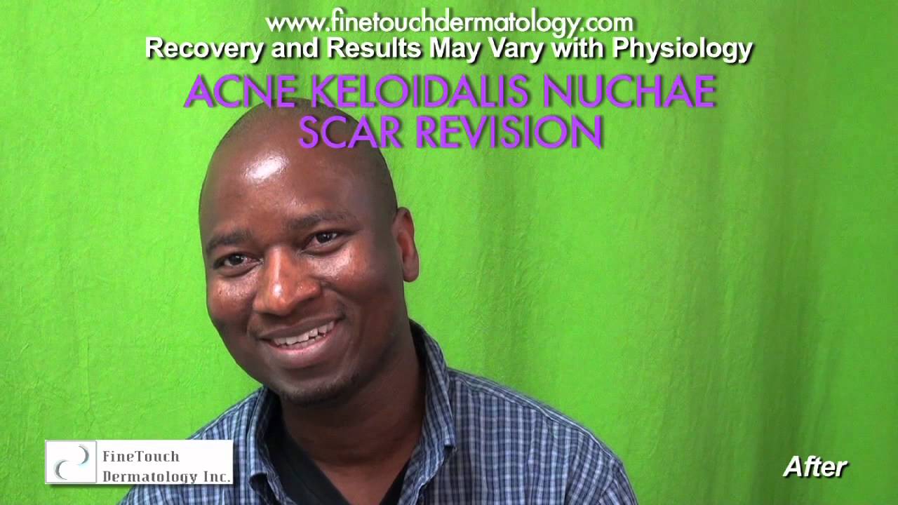 Acne Keloidalis Nuchae Scar Revision Surgery AKN Surgery Revision
